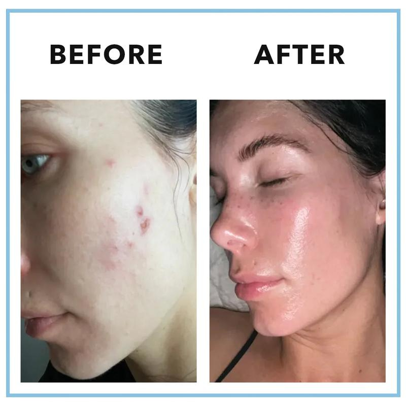 Hormonal Acne Supplement
